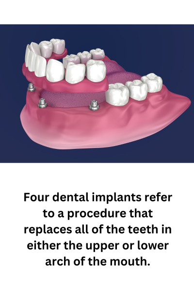 Four dental implants refer to a procedure that replaces all of the teeth in either the upper or lower arch of the mouth.