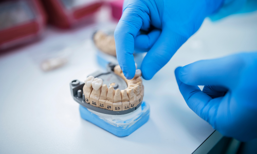 WHO IS A CANDIDATE FOR A DENTAL BRIDGE?