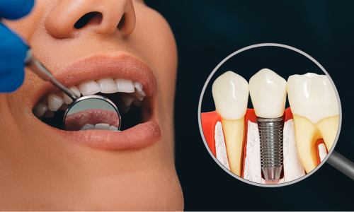 WHAT TO EXPECT DURING THE DENTAL IMPLANT PROCESS?