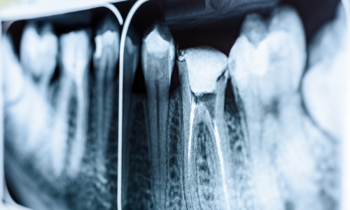 WHAT MAKES SOMEONE A CANDIDATE FOR ENDODONTIC TREATMENT?
