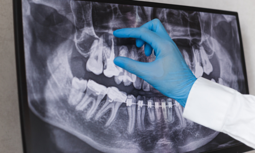 WHO IS A CANDIDATE FOR ROOT CANALS?