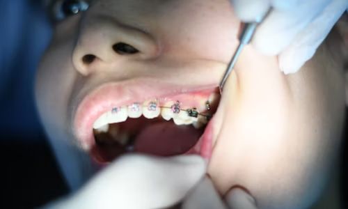 Who Needs Dental Braces? What is the Procedure for Adding Braces?
