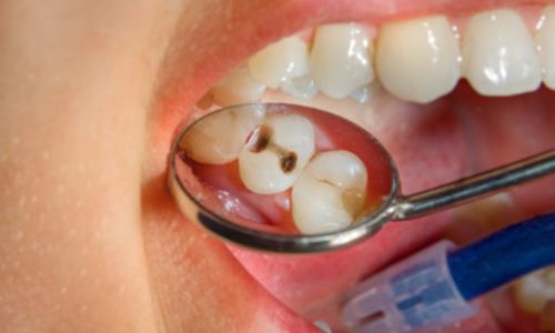 What Are The Major Causes Of Cavities In Teeth?