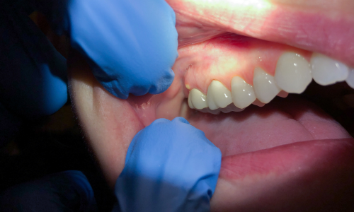 Different Natures of Dental Emergencies You Can Encounter