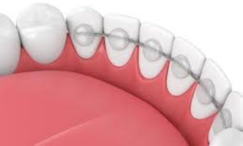 Are Permanent Retainers the Right Choice for You?