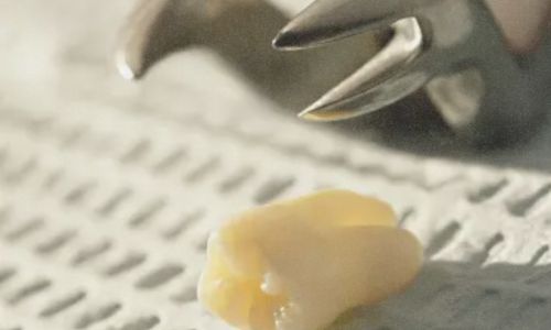 Types of Tooth Extractions: Simple vs. Surgical Procedures