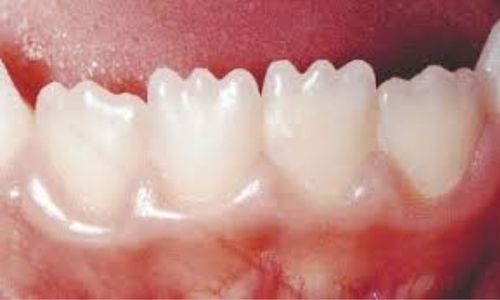 Unveiling Mamelons Teeth: Definition, Causes, and Solutions