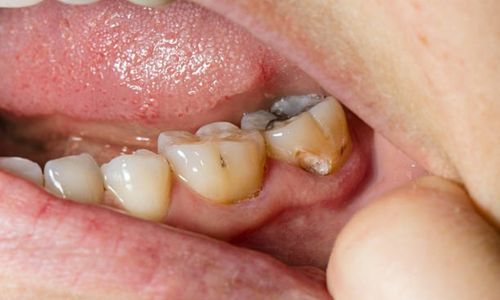 stain vs cavity molar