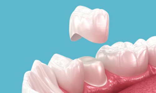 Tooth Sore After Crown: Causes, Treatments, and Prevention