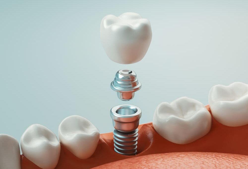 Dental Implants: Your Journey to a Restored Smile