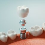Dental Implants: Your Journey to a Restored Smile