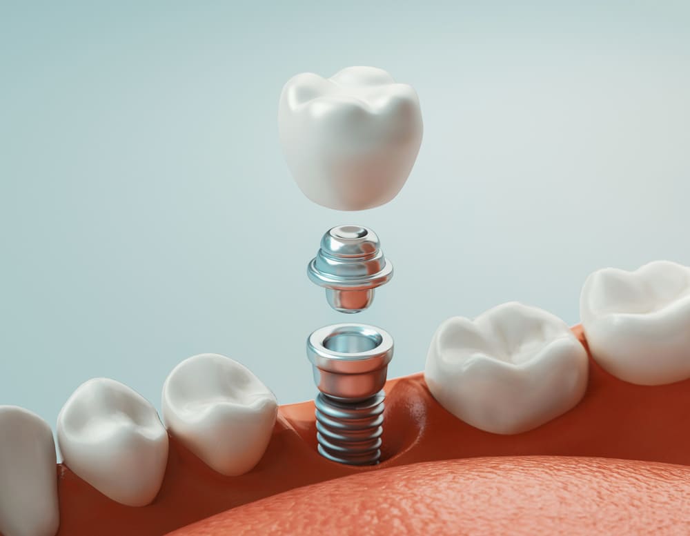 Dental Implants: Your Journey to a Restored Smile
