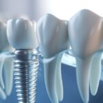 Single Tooth Implant: Complete Replacement Guide