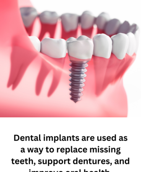 Dental implants are used as a way to replace missing teeth, support dentures, and improve oral health.